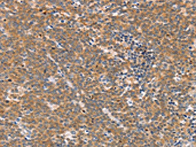 The image on the left is immunohistochemistry of paraffin-embedded Human Lymphoma tissue using the antibody Antibody) at dilution 1/70, on the right is treated with synthetic peptide. (Original magnification: ×200)Rabbit anti-Human CD2AP Polyclonal Antibody