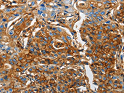 The image on the left is immunohistochemistry of paraffin-embedded Human lung cancer tissue using B2M Antibody(B2M Antibody) at dilution 1/25, on the right is treated with fusion protein. (Original magnification: ×200)Rabbit anti-Human B2M Polyclonal Antibody