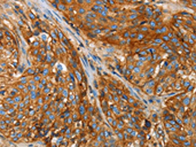 The image on the left is immunohistochemistry of paraffin-embedded Human esophagus cancer tissue using the antibody Antibody) at dilution 1/25, on the right is treated with fusion protein. (Original magnification: ×200)Rabbit anti-Human B2M Polyclonal Antibody
