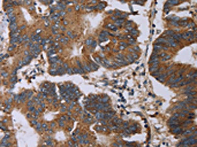 The image on the left is immunohistochemistry of paraffin-embedded Human colon cancer tissue using MAP3K11 Antibody(MAP3K11 Antibody) at dilution 1/40, on the right is treated with synthetic peptide. (Original magnification: ×200)