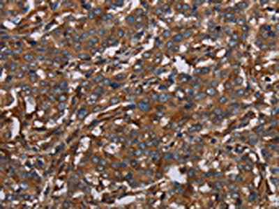 The image on the left is immunohistochemistry of paraffin-embedded Human liver cancer tissue using the antibody Antibody) at dilution 1/40, on the right is treated with synthetic peptide. (Original magnification: ×200)