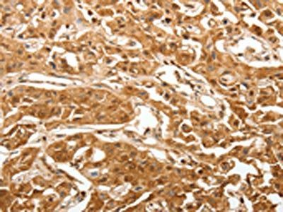 The image on the left is immunohistochemistry of paraffin-embedded Human lung cancer tissue using TXN Antibody(TXN Antibody) at dilution 1/40, on the right is treated with synthetic peptide. (Original magnification: ×200)Rabbit anti-Human TXN Polyclonal Antibody