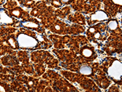 The image on the left is immunohistochemistry of paraffin-embedded Human thyroid cancer tissue using the antibody Antibody) at dilution 1/40, on the right is treated with synthetic peptide. (Original magnification: ×200)Rabbit anti-Human TXN Polyclonal Antibody