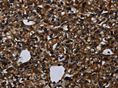 The image on the left is immunohistochemistry of paraffin-embedded Human prostate cancer tissue using KLK14 Antibody(KLK14 Antibody) at dilution 1/40, on the right is treated with synthetic peptide. (Original magnification: ×200)Rabbit anti-Human KLK14 Polyclonal Antibody