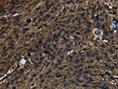 The image on the left is immunohistochemistry of paraffin-embedded Human esophagus cancer tissue using the antibody Antibody) at dilution 1/40, on the right is treated with synthetic peptide. (Original magnification: ×200)