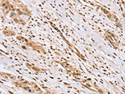 The image on the left is immunohistochemistry of paraffin-embedded Human esophagus cancer tissue using CENPV Antibody(CENPV Antibody) at dilution 1/40, on the right is treated with synthetic peptide. (Original magnification: ×200)Rabbit anti-Human CENPV Polyclonal Antibody