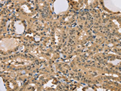 The image on the left is immunohistochemistry of paraffin-embedded Human thyroid cancer tissue using the antibody Antibody) at dilution 1/40, on the right is treated with synthetic peptide. (Original magnification: ×200)Rabbit anti-Human CENPV Polyclonal Antibody