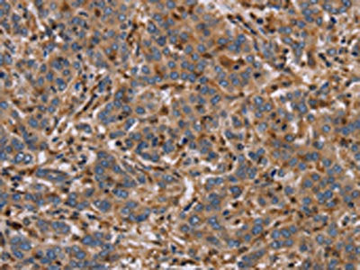 The image on the left is immunohistochemistry of paraffin-embedded Human liver cancer tissue using ETV7 Antibody(ETV7 Antibody) at dilution 1/40, on the right is treated with fusion protein. (Original magnification: ×200)Rabbit anti-Human ETV7 Polyclonal Antibody