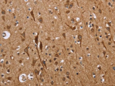 The image on the left is immunohistochemistry of paraffin-embedded Human brain tissue using the antibody Antibody) at dilution 1/40, on the right is treated with fusion protein. (Original magnification: ×200)Rabbit anti-Human ETV7 Polyclonal Antibody