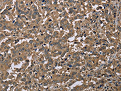 The image on the left is immunohistochemistry of paraffin-embedded Human liver cancer tissue using CAB39 Antibody(CAB39 Antibody) at dilution 1/40, on the right is treated with synthetic peptide. (Original magnification: ×200)