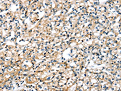 The image on the left is immunohistochemistry of paraffin-embedded Human prostate cancer tissue using the antibody Antibody) at dilution 1/30, on the right is treated with fusion protein. (Original magnification: X200)Rabbit anti-Human SRPX Polyclonal Antibody