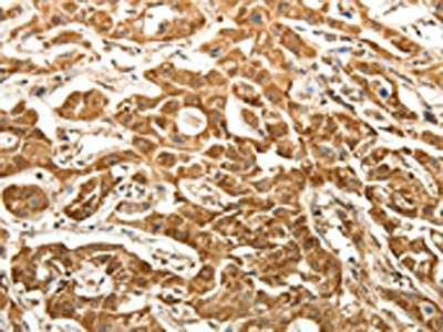 The image on the left is immunohistochemistry of paraffin-embedded Human lung cancer tissue using PTCH1 Antibody(PTCH1 Antibody) at dilution 1/40, on the right is treated with fusion protein. (Original magnification: ×200)Rabbit anti-Human PTCH1 Polyclonal Antibody