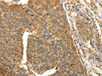 The image on the left is immunohistochemistry of paraffin-embedded Human liver cancer tissue using the antibody Antibody) at dilution 1/40, on the right is treated with fusion protein. (Original magnification: ×200)Rabbit anti-Human PTCH1 Polyclonal Antibody