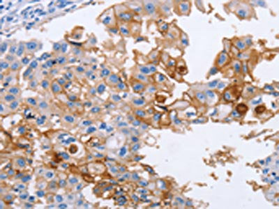 The image on the left is immunohistochemistry of paraffin-embedded Human breast cancer tissue using ICAM1 Antibody(ICAM1 Antibody) at dilution 1/40, on the right is treated with synthetic peptide. (Original magnification: ×200)Rabbit anti-Human ICAM1 Polyclonal Antibody