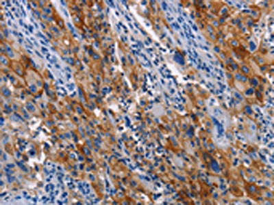 The image on the left is immunohistochemistry of paraffin-embedded Human lung cancer tissue using the antibody Antibody) at dilution 1/40, on the right is treated with synthetic peptide. (Original magnification: ×200)Rabbit anti-Human ICAM1 Polyclonal Antibody
