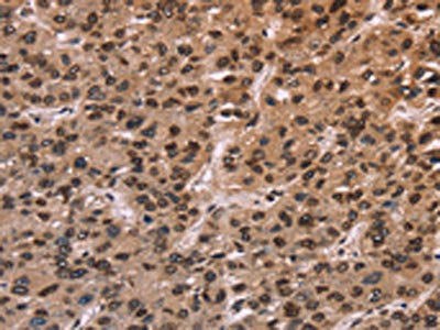 The image on the left is immunohistochemistry of paraffin-embedded Human liver cancer tissue using LMNB1 Antibody(LMNB1 Antibody) at dilution 1/60, on the right is treated with fusion protein. (Original magnification: ×200)