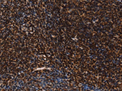 The image on the left is immunohistochemistry of paraffin-embedded Human tonsil tissue using the antibody Antibody) at dilution 1/60, on the right is treated with fusion protein. (Original magnification: ×200)
