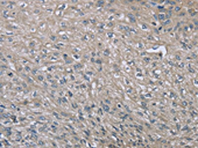 The image on the left is immunohistochemistry of paraffin-embedded Human esophagus cancer tissue using EZR Antibody(EZR Antibody) at dilution 1/20, on the right is treated with fusion protein. (Original magnification: ×200)Rabbit anti-Human EZR Polyclonal Antibody
