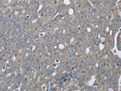 The image on the left is immunohistochemistry of paraffin-embedded Human ovarian cancer tissue using the antibody Antibody) at dilution 1/20, on the right is treated with fusion protein. (Original magnification: ×200)Rabbit anti-Human EZR Polyclonal Antibody