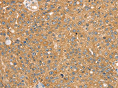 The image on the left is immunohistochemistry of paraffin-embedded Human breast cancer tissue using SNX2 Antibody(SNX2 Antibody) at dilution 1/40, on the right is treated with synthetic peptide. (Original magnification: ×200)Rabbit anti-Human SNX2 Polyclonal Antibody