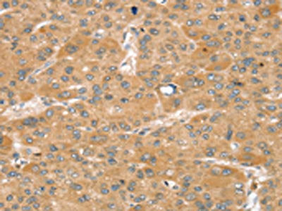The image on the left is immunohistochemistry of paraffin-embedded Human liver cancer tissue using the antibody Antibody) at dilution 1/40, on the right is treated with synthetic peptide. (Original magnification: ×200)Rabbit anti-Human SNX2 Polyclonal Antibody