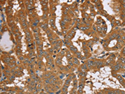The image on the left is immunohistochemistry of paraffin-embedded Human thyroid cancer tissue using RAB14 Antibody(RAB14 Antibody) at dilution 1/40, on the right is treated with synthetic peptide. (Original magnification: ×200)Rabbit anti-Human RAB14 Polyclonal Antibody