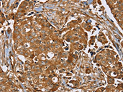 The image on the left is immunohistochemistry of paraffin-embedded Human breast cancer tissue using the antibody Antibody) at dilution 1/40, on the right is treated with synthetic peptide. (Original magnification: ×200)Rabbit anti-Human RAB14 Polyclonal Antibody