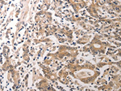 The image on the left is immunohistochemistry of paraffin-embedded Human gastric cancer tissue using CCR3 Antibody(CCR3 Antibody) at dilution 1/40, on the right is treated with synthetic peptide. (Original magnification: ×200)Rabbit anti-Human CCR3 Polyclonal Antibody
