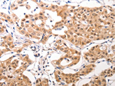 The image on the left is immunohistochemistry of paraffin-embedded Human lung cancer tissue using the antibody Antibody) at dilution 1/40, on the right is treated with synthetic peptide. (Original magnification: ×200)Rabbit anti-Human CCR3 Polyclonal Antibody