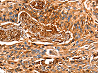 The image on the left is immunohistochemistry of paraffin-embedded Human esophagus cancer tissue using LGALS1 Antibody(LGALS1 Antibody) at dilution 1/25, on the right is treated with fusion protein. (Original magnification: ×200)