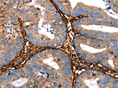 The image on the left is immunohistochemistry of paraffin-embedded Human cervical cancer tissue using the antibody Antibody) at dilution 1/25, on the right is treated with fusion protein. (Original magnification: ×200)
