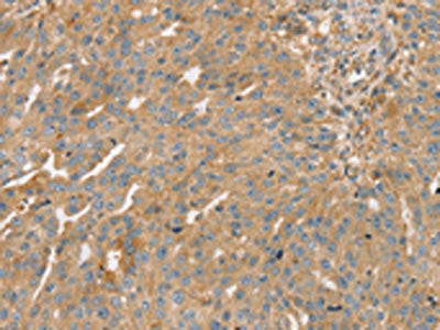 The image on the left is immunohistochemistry of paraffin-embedded Human breast cancer tissue using STX16 Antibody(STX16 Antibody) at dilution 1/30, on the right is treated with fusion protein. (Original magnification: ×200)Rabbit anti-Human STX16 Polyclonal Antibody