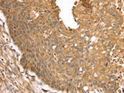 The image on the left is immunohistochemistry of paraffin-embedded Human esophagus cancer tissue using the antibody Antibody) at dilution 1/30, on the right is treated with fusion protein. (Original magnification: ×200)Rabbit anti-Human STX16 Polyclonal Antibody