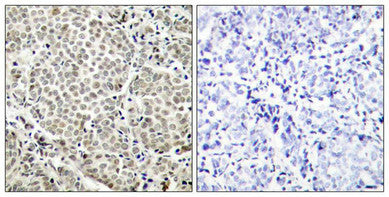 Immunohistochemical analysis of paraffin-embedded human breast carcinoma tissue using NFkB-p65(Phospho-Ser529) Antibody(left) or the same antibody preincubated with blocking peptide(right).Rabbit anti-Human RELA Polyclonal Antibody
