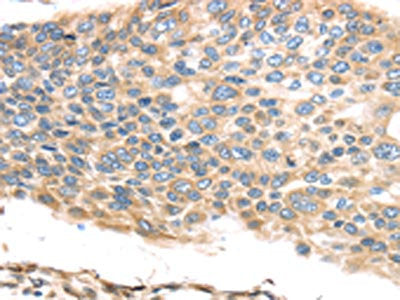 The image on the left is immunohistochemistry of paraffin-embedded Human esophagus cancer tissue using TMED2 Antibody(TMED2 Antibody) at dilution 1/30, on the right is treated with fusion protein. (Original magnification: ×200)Rabbit anti-Human TMED2 Polyclonal Antibody
