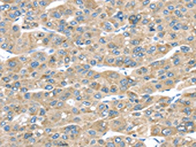The image on the left is immunohistochemistry of paraffin-embedded Human liver cancer tissue using the antibody Antibody) at dilution 1/30, on the right is treated with fusion protein. (Original magnification: ×200)Rabbit anti-Human TMED2 Polyclonal Antibody