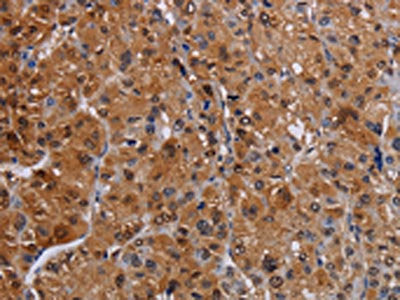 The image on the left is immunohistochemistry of paraffin-embedded Human liver cancer tissue using LIMS1 Antibody(LIMS1 Antibody) at dilution 1/30, on the right is treated with fusion protein. (Original magnification: ×200)