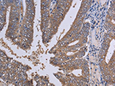 The image on the left is immunohistochemistry of paraffin-embedded Human colon cancer tissue using the antibody Antibody) at dilution 1/30, on the right is treated with fusion protein. (Original magnification: ×200)