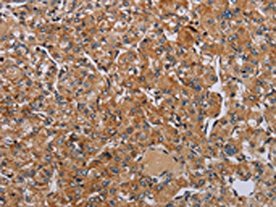 The image on the left is immunohistochemistry of paraffin-embedded Human prostate cancer tissue using NDUFA8 Antibody(NDUFA8 Antibody) at dilution 1/30, on the right is treated with synthetic peptide. (Original magnification: ×200)Rabbit anti-Human NDUFA8 Polyclonal Antibody