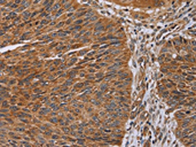 The image on the left is immunohistochemistry of paraffin-embedded Human lung cancer tissue using the antibody Antibody) at dilution 1/30, on the right is treated with synthetic peptide. (Original magnification: ×200)Rabbit anti-Human NDUFA8 Polyclonal Antibody