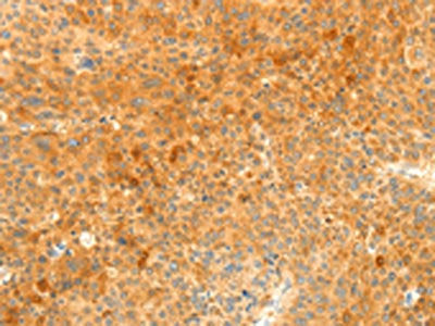 The image on the left is immunohistochemistry of paraffin-embedded Human liver cancer tissue using SOCS6 Antibody(SOCS6 Antibody) at dilution 1/35, on the right is treated with fusion protein. (Original magnification: ×200)Rabbit anti-Human SOCS6 Polyclonal Antibody