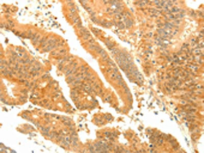 The image on the left is immunohistochemistry of paraffin-embedded Human colon cancer tissue using the antibody Antibody) at dilution 1/35, on the right is treated with fusion protein. (Original magnification: ×200)Rabbit anti-Human SOCS6 Polyclonal Antibody