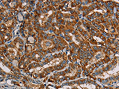 The image on the left is immunohistochemistry of paraffin-embedded Human thyroid cancer tissue using the antibody Antibody) at dilution 1/45, on the right is treated with fusion protein. (Original magnification: ×200)Rabbit anti-Human MRPL39 Polyclonal Antibody