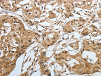 The image on the left is immunohistochemistry of paraffin-embedded Human lung cancer tissue using AMPH Antibody(AMPH Antibody) at dilution 1/30, on the right is treated with fusion protein. (Original magnification: ×200)Rabbit anti-Human AMPH Polyclonal Antibody