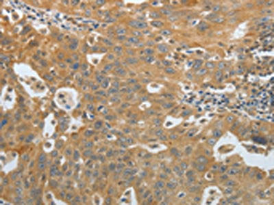 The image on the left is immunohistochemistry of paraffin-embedded Human ovarian cancer tissue using the antibody Antibody) at dilution 1/30, on the right is treated with fusion protein. (Original magnification: ×200)Rabbit anti-Human AMPH Polyclonal Antibody
