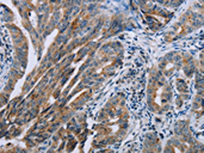 The image on the left is immunohistochemistry of paraffin-embedded Human gastic cancer tissue using the antibody Antibody) at dilution 1/40, on the right is treated with synthetic peptide. (Original magnification: ×200)Rabbit anti-Human PNPT1 Polyclonal Antibody
