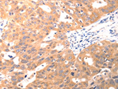The image on the left is immunohistochemistry of paraffin-embedded Human ovarian cancer tissue using the antibody Antibody) at dilution 1/60, on the right is treated with fusion protein. (Original magnification: ×200)