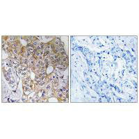 Immunohistochemistry analysis of paraffin-embedded human breast carcinoma tissue, using CCT6A antibody.Rabbit anti-Human CCT6A Polyclonal Antibody