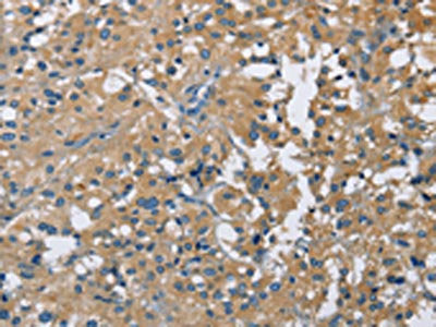 The image on the left is immunohistochemistry of paraffin-embedded Human thyroid cancer tissue using the antibody Antibody) at dilution 1/40, on the right is treated with fusion protein. (Original magnification: ×200)