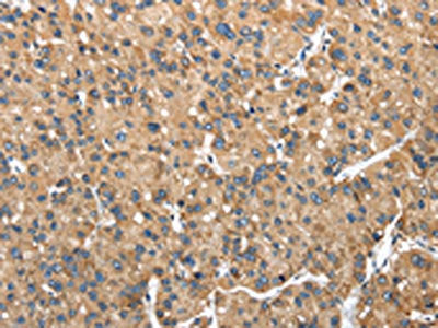 The image on the left is immunohistochemistry of paraffin-embedded Human liver cancer tissue using NDUFA5 Antibody(NDUFA5 Antibody) at dilution 1/40, on the right is treated with fusion protein. (Original magnification: ×200)Rabbit anti-Human NDUFA5 Polyclonal Antibody